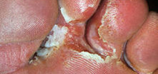 грибковые поражения кожи