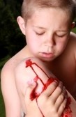 кровотечение у ребенка